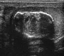 Fig. 5. Teratoma. A plaque-like calcification with acoustic shadow is seen in the testis.[citation needed]