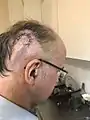 Head wound at day 6