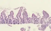 Tropical enteropathy, environmental enteric dysfunction