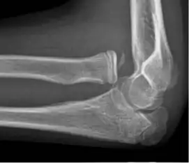 X-ray of ventral dislocation of the radial head. There is calcification of annular ligament, which can be seen as early as 2 weeks after injury.