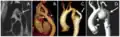 Aortic coarctation using different imaging techniqes