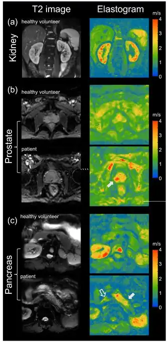 Tomoelastography of Kidney Prostate and Pancreas