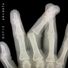 X-ray image of a hand with a broken middle finger