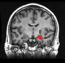 MRI coronal view of a hippocampus shown in red.