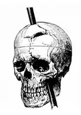 A diagram of Gage's skull after being impaled by the iron