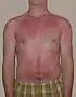 A sunburn is a typical first degree burn.