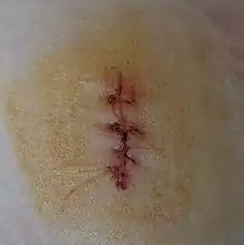 Wound, sewed with four stitches