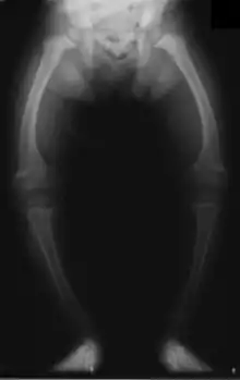 x-ray of child with rickets