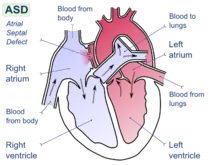 Diagram of the four chambers of the heart. There is a gap in the wall between the upper-left and upper-right chambers